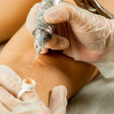 Scar camouflage therapy with rotative machine